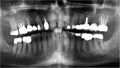 Selective root canal retreatment of a maxillary first molar: a case report with a 9-year follow up